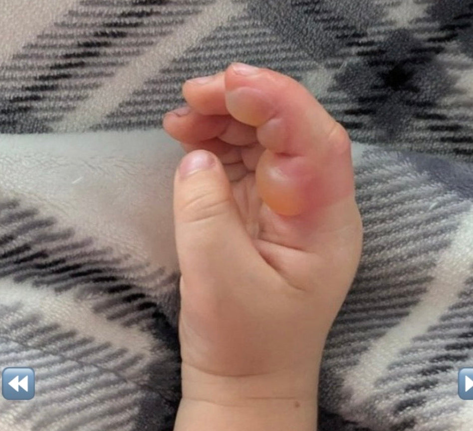 Close-up of a baby's hand on a patterned blanket swollen and blistered from pacifer
